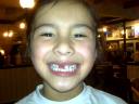 Tooth 2 Falls Out